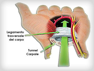 TunnelCarpale